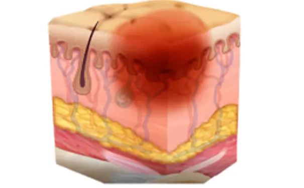 杭州博养压疮治疗中 杭州博养压疮治疗中