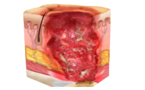 杭州博养压疮治疗中 杭州博养压疮治疗中