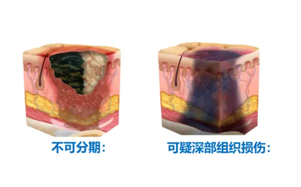 杭州博养压疮治疗中 杭州博养压疮治疗中