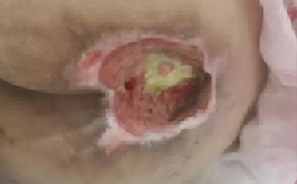 杭州博养压疮治疗中心 杭州博养压疮治疗中心