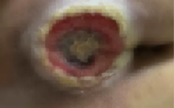 杭州博养压疮治疗中心 杭州博养压疮治疗中心