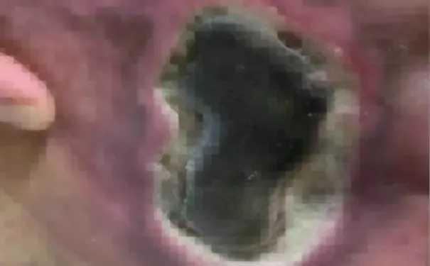 杭州博养压疮治疗中心 杭州博养压疮治疗中心