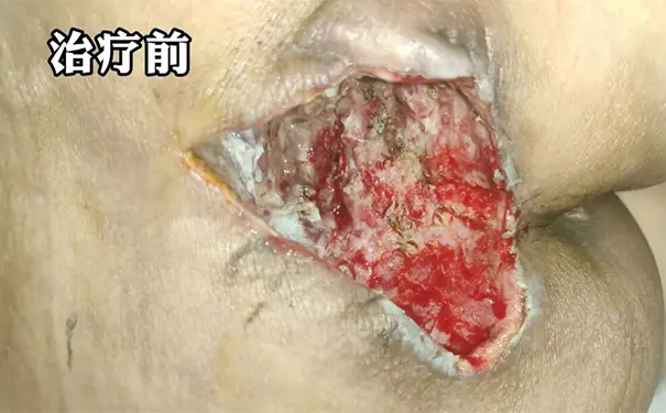 杭州博养压疮治疗中心 杭州博养压疮治疗中心