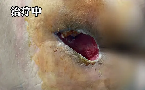 杭州博养压疮治疗中心 杭州博养压疮治疗中心