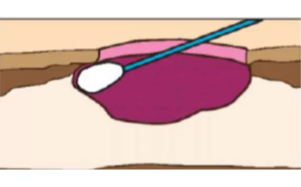 杭州博养压疮治疗中心 杭州博养压疮治疗中心