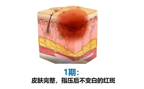 杭州博养压疮治疗中心 杭州博养压疮治疗中心