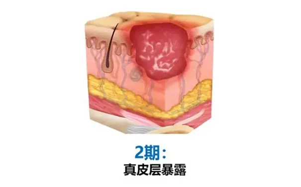 杭州博养压疮治疗中心 杭州博养压疮治疗中心