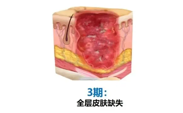 杭州博养压疮治疗中心 杭州博养压疮治疗中心