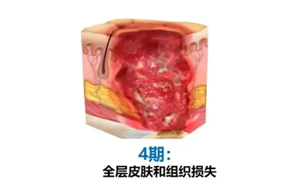 杭州博养压疮治疗中心 杭州博养压疮治疗中心