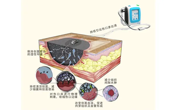 杭州博养压疮治疗中心