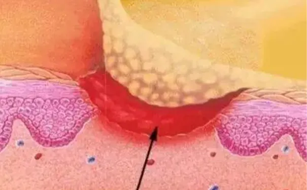 杭州博养压疮治疗中心 杭州博养压疮治疗中心