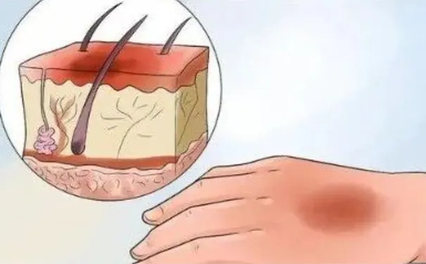 杭州博养压疮治疗中心