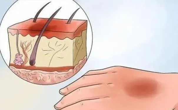 杭州博养压疮治疗中心