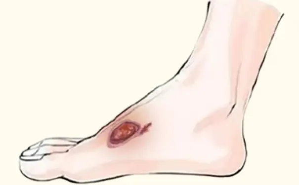 杭州博养压疮治疗中心